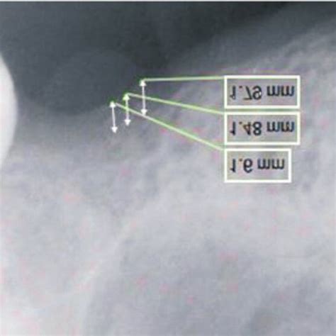 measurement of mucosal thickness of trachea mycoplasma|Th.